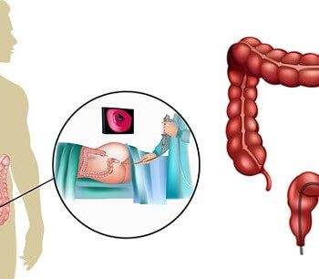gastroskopi kolonoskopi