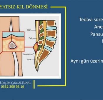 ameliyatsız kıl dönmesi tedavisi