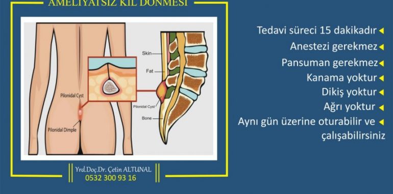 ameliyatsız kıl dönmesi tedavisi