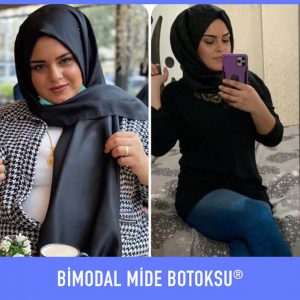 bimodal-mide-botoksu-once-sonra-10