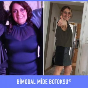 bimodal-mide-botoksu-once-sonra-11