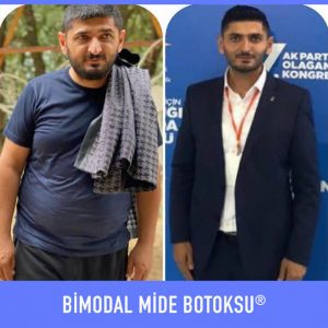 bimodal-mide-botoksu-once-sonra-12