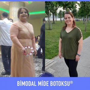 bimodal-mide-botoksu-once-sonra-2