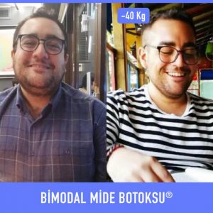 bimodal-mide-botoksu-once-sonra-3