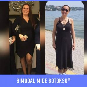 bimodal-mide-botoksu-once-sonra