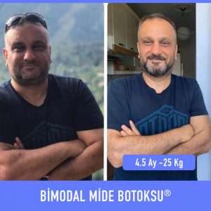 bimodal-mide-botoksu-once-sonra-4