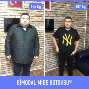 bimodal-mide-botoksu-once-sonra-5