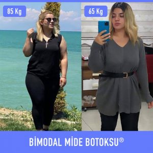 bimodal-mide-botoksu-once-sonra-6