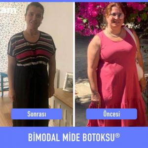 bimodal-mide-botoksu-once-sonra-7