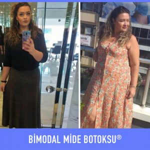 bimodal-mide-botoksu-once-sonra-8