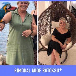 bimodal-mide-botoksu-once-sonra-9