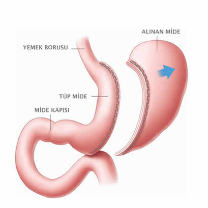 tüp mide ameliyatı nedir?