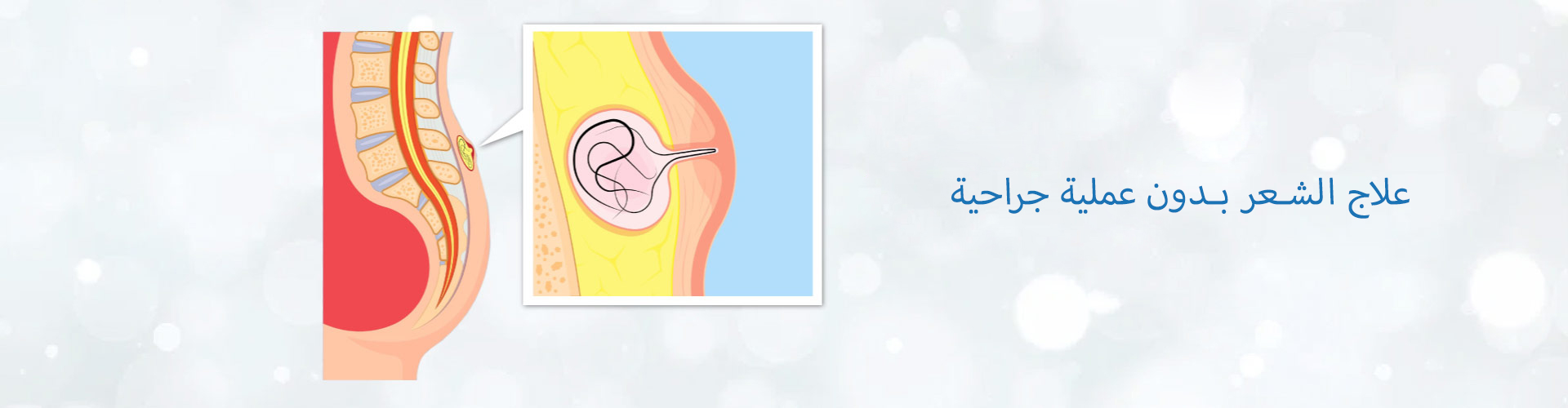 منزلق علاج الذبحة الصدرية غير الجراحية