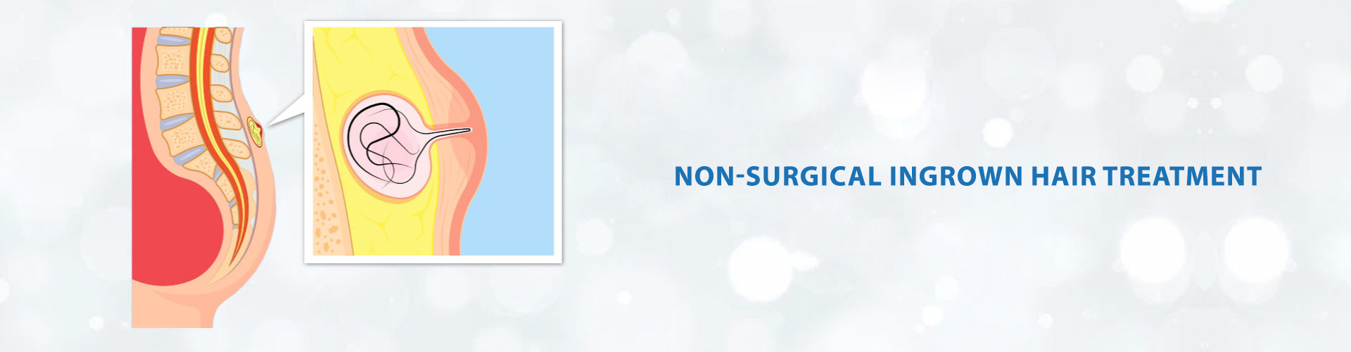 non-surgical angina treatment slider