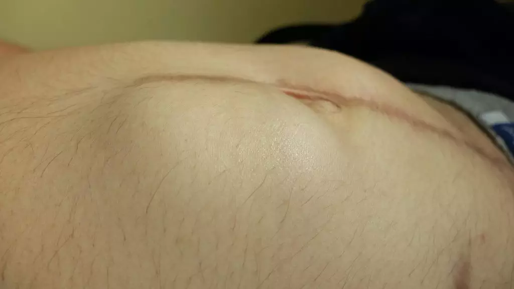 incision site hernia