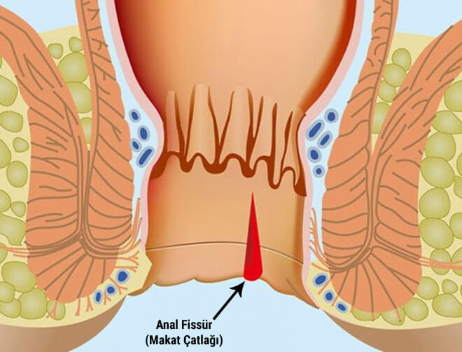 Anal Fistül Çeşitleri