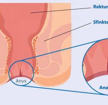 Anal Fistül Nedir?