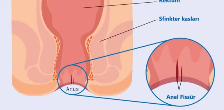 Anal Fistül Nedir?