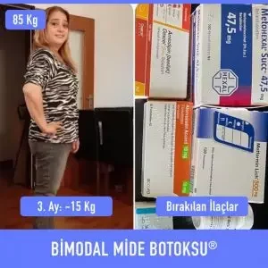 bimodal-mide-botoksu-once-sonra-1-300×300