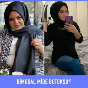 bimodal-mide-botoksu-once-sonra-10-300×300