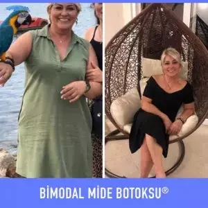 bimodal-mide-botoksu-once-sonra-9-300×300