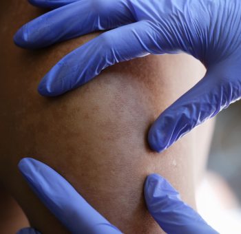 lipoma