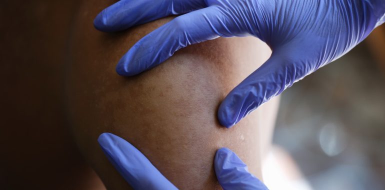 lipoma